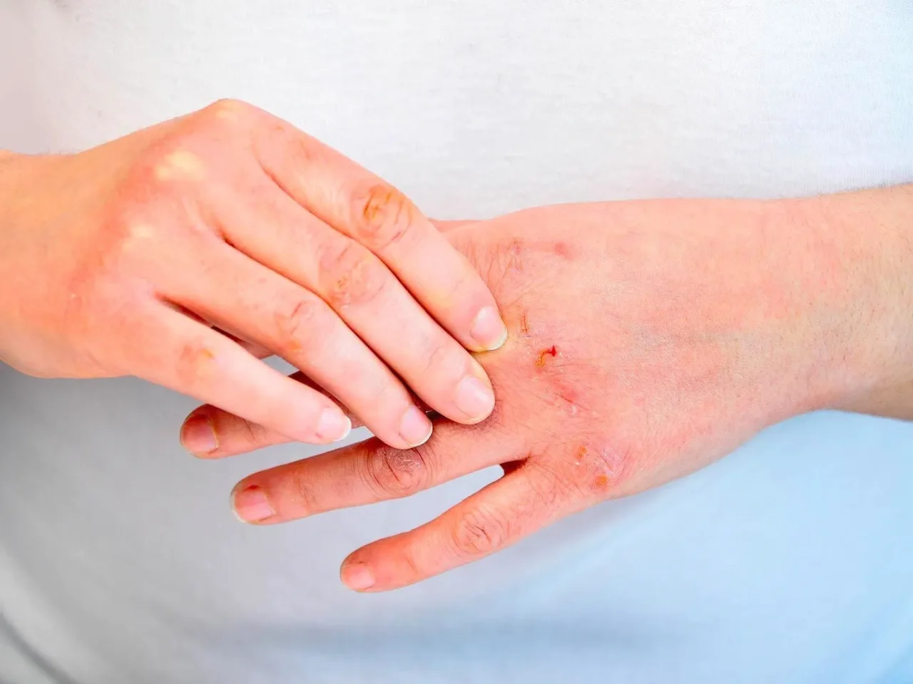 Come eliminare definitivamente la dermatite? Ecco il consiglio del dermatologo